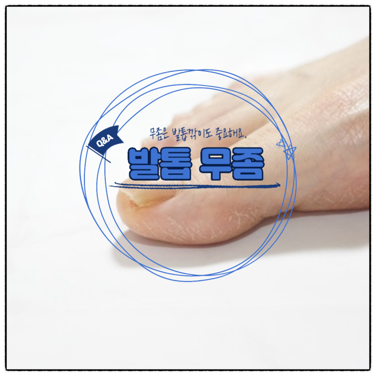 무좀 발톱무좀 증상. 두꺼운 발톱 발톱깎이 : 네이버 블로그