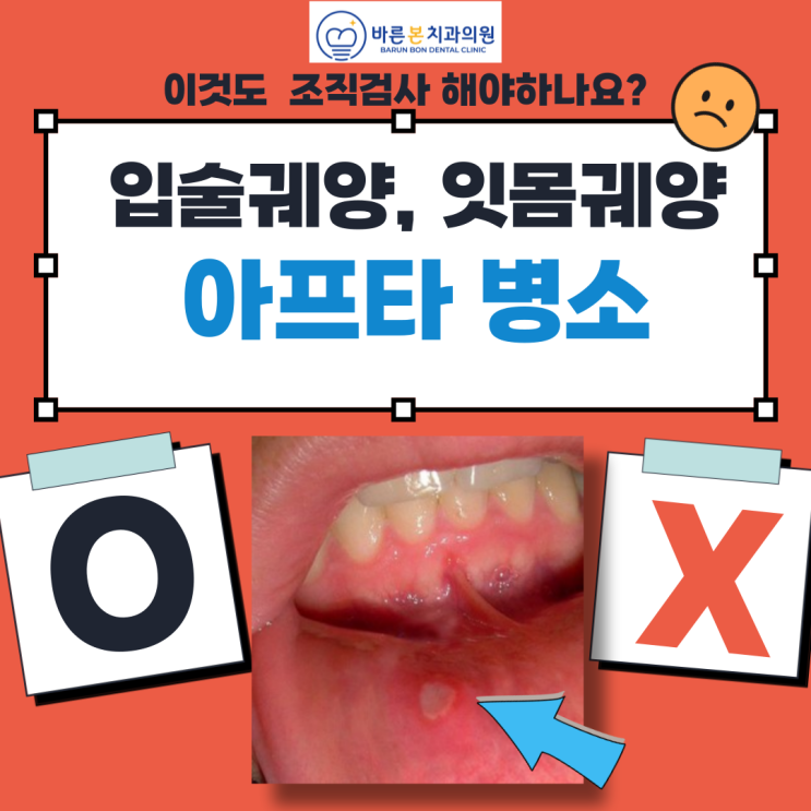 입술궤양, 아프타구내염 전염과 치료에 대한 모든 것! : 네이버 블로그