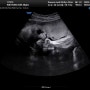 [ 임신일기 ] 36주차 :: 막달검사, 임산부 독감주사, 헤르페스