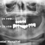 인계동 치과 : 전체 임플란트 식립해 드리기