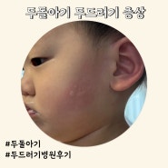 21개월 두돌 아기 얼굴 몸 두드러기 원인 병원방문 후기