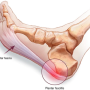 발바닥근막염 족저근막염 足底筋膜炎 plantar fasciitis 포항 오천한의원 허한의원