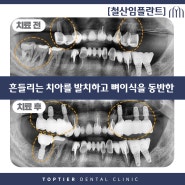 철산임플란트 흔들리는 치아를 발치하고 뼈이식을 동반한