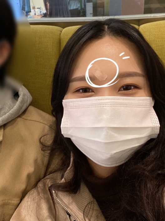 점뺀후 일주일 관리방법! 듀오덤교체, 점빼고 난 후 진물 안나게 : 네이버 블로그 점뺀후 일주일 관리방법! 듀오덤교체, 점빼고 난 후 진물 안나게 : 네이버 블로그
