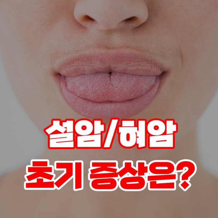 설암(혀암) 초기증상, 증상 알고 있는 것이 좋습니다. : 네이버 블로그