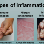 화농성 염증 (pyogenic inflammation)