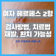 여자 성병 헤르페스 2형 특징 검사 치료 재발 완치 알아보기