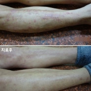 다리 가려움 종아리에 발생한 습진 병변 치료사례