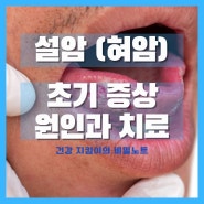 설암(혀암) 초기 증상 사진 원인 치료