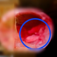 자궁내막용종 폴립 자궁경 제거 & 소파술