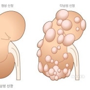 다낭신 환자 결혼해도 될까? 임신해도 될까? [투석/뇌수술/가족력]