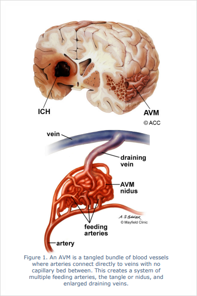 자465 뇌동정맥기형 적출술 Operation of Cerebral ArteriovenousMalformation, AVM 의 ...