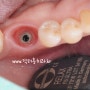 임플란트 치아가 흔들리는 경우 대처방법