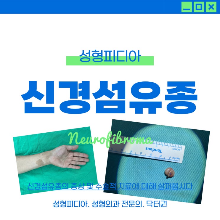 [양성종양] 신경섬유종 제거 수술은 어떻게 하나요? (feat. 성형외과 전문의) : 네이버 블로그