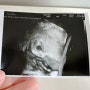 [임신기록] 임신 32주, 1월 초 예정일 아기, 제왕절개수술 날짜 잡기