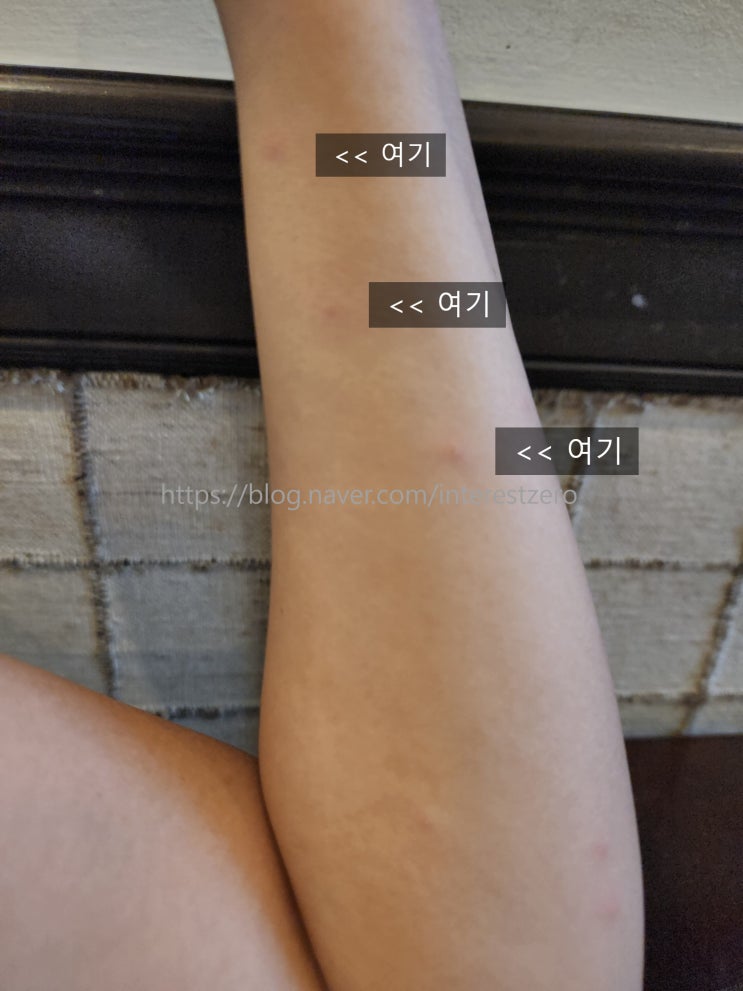 빈대 물린자국 베드버그 증상 약국 병원 치료 찐 후기 : 네이버 블로그