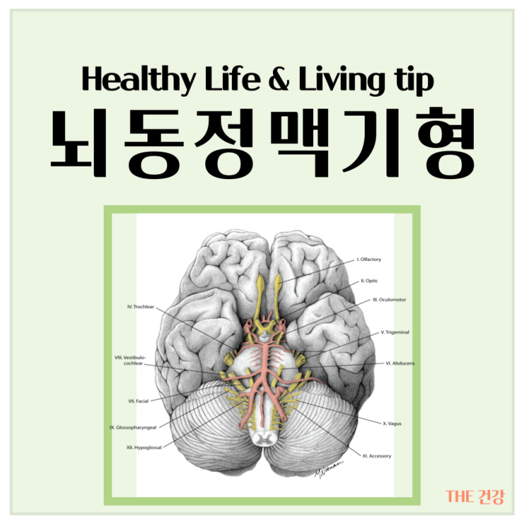 뇌동정맥기형 원인과 증상 진단 치료방법 자세히 알아보기 : 네이버 블로그