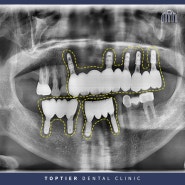 광명임플란트잘하는곳 치아상실로 식사가 불편해요