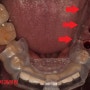 매교역 치과 : 디지털가이드 임플란트