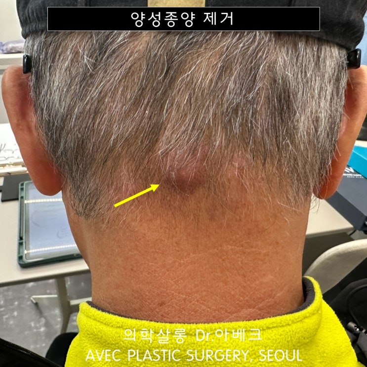 Dr. 아베크 【양성종양】 목 피지낭종/표피낭종 제거 후기 : 네이버 블로그