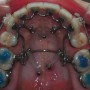 킬본 치아교정기의 돌출입 발치교정 효과와 치아교정 기간
