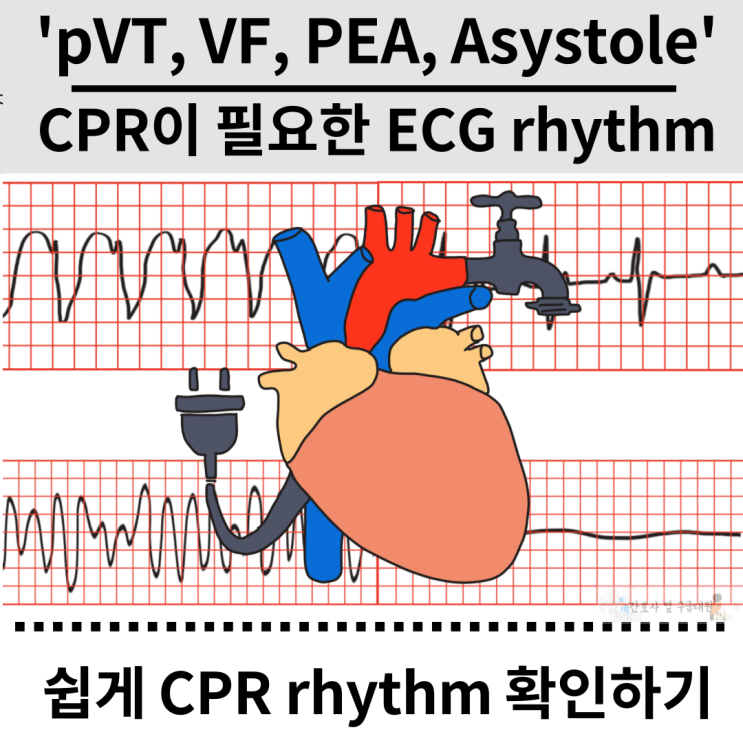 CPR이 필요한 ECG rhythm : pulseless V-tach, V-fib, PEA, Asystole : 네이버 블로그