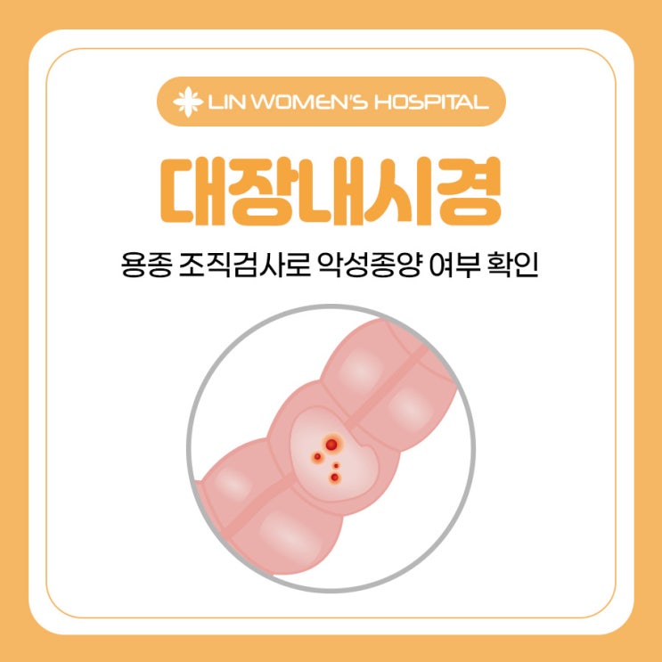 대장내시경 용종 조직검사로 악성종양 여부 확인 : 네이버 블로그