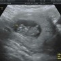 [12주 0일]1차기형아검사,니프티검사,초기임신중독증검사 후기