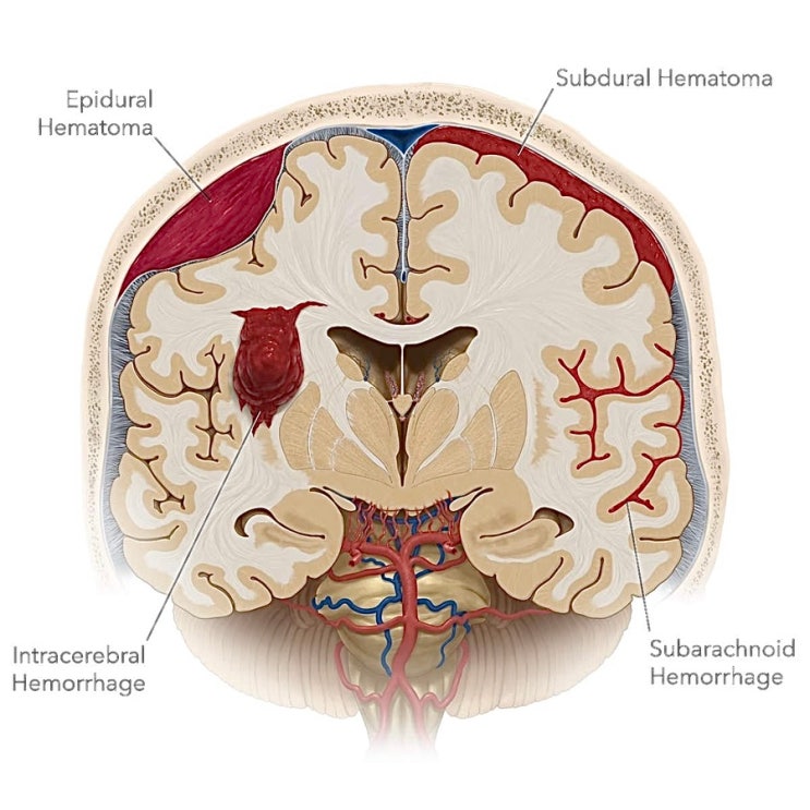 뇌출혈 지주막하출혈 거미막하출혈 SAH subarachnoid hemorrhage 증상 원인 치료 수술 예후 합병증 ...