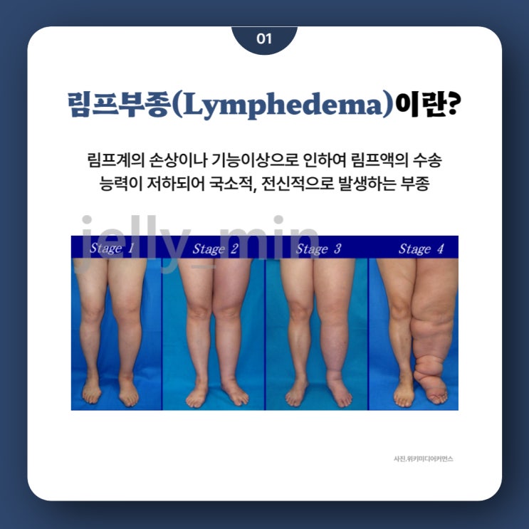 림프부종(Lymphedema)이란??? : 네이버 블로그