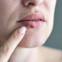 입술 물집 헤르페스 구내염, 생기는 이유와 올바른 약 바르기 방법