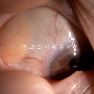 눈 이물감 안와 지방 탈출ㅣ실제 수술 후기