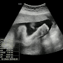 [임신 29주]+5일 임신 후기 태아 초음파, 아기 머리카락 발견, 29주~30주 증상