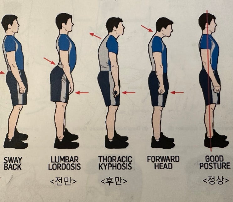 당신의 체형은 어디에 속하나요? (요추전만,요추후만,스웨이백,측만) : 네이버 블로그