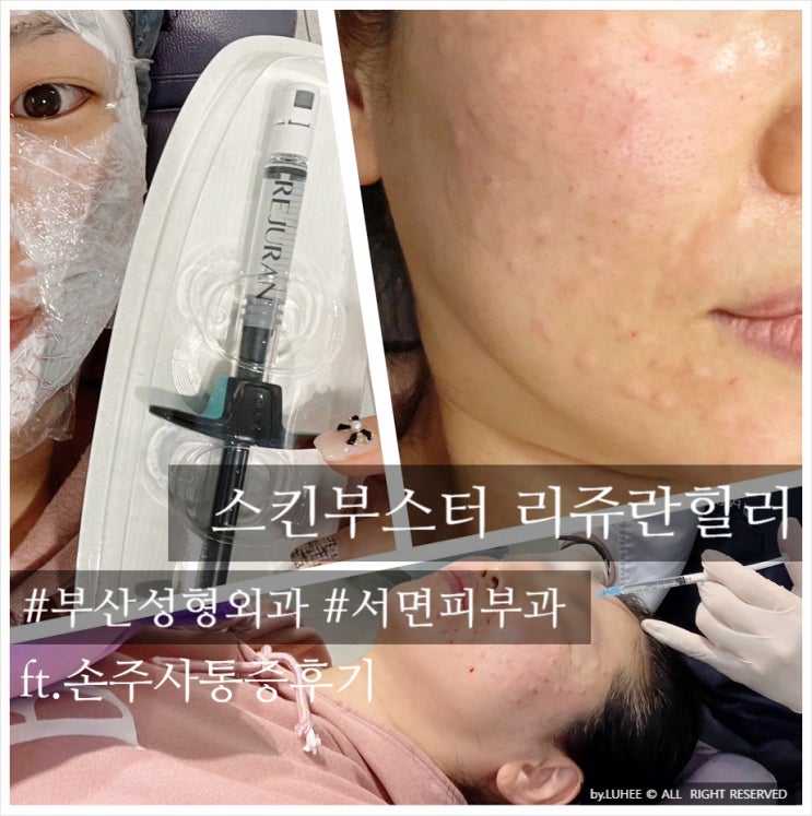 [ 서면 피부과 리쥬란힐러 ] 부산진구 성형외과 피부과 속건조 해결 피부시술 손주사 리쥬란 힐러 마취 / 통증 / 후기(ft ...