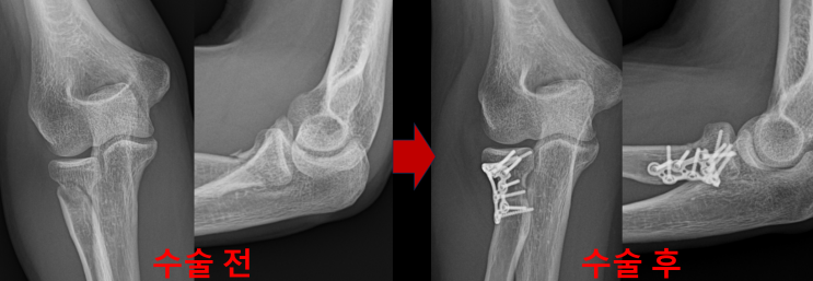 팔꿈치 골절에서 흔한 요골 경부 골절 (Radial neck Fracture) 수술적치료의 교과서적인 적응증, 수술 전과 후의 ...