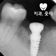 치아 뿌리 염증 심해도 발치 후 즉시 임플란트 될까요?