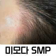 MIMODA SMP (Scalp Micro Pigmentation)