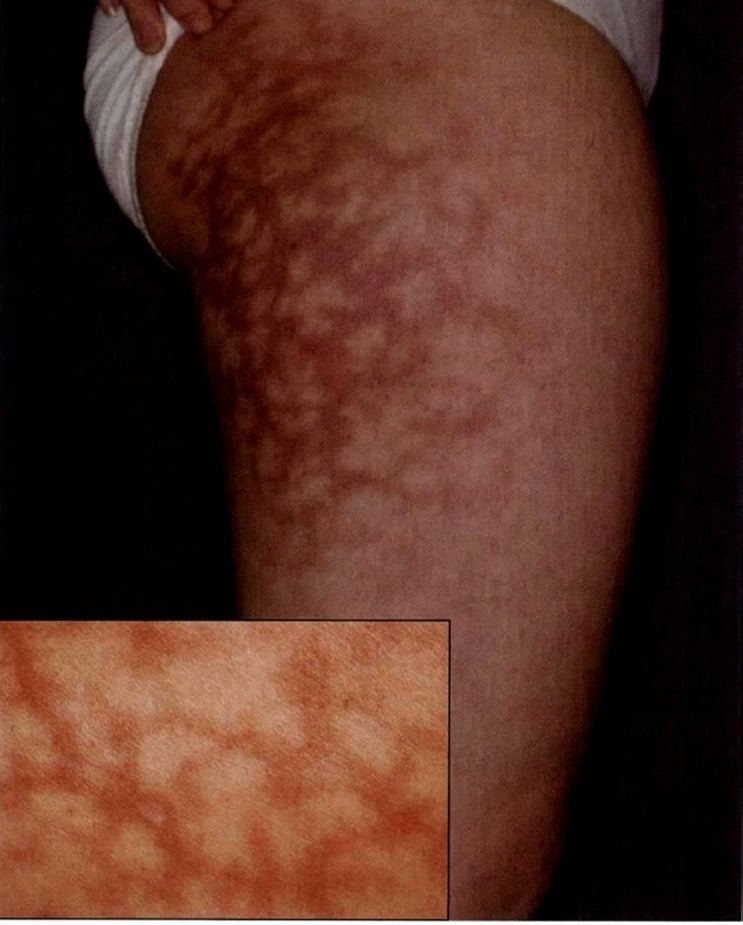 따뜻한 게 좋았을 뿐인데 그물 모양의 얼룩이 생긴다 열성홍반 (Erythema ab igne) 네이버 블로그