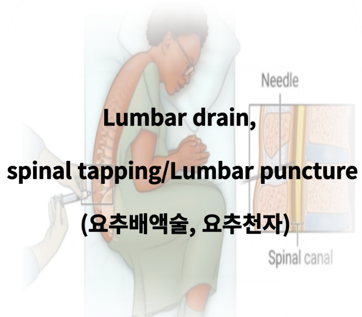 Lumbar drain, spinal tapping/Lumbar puncture (요추배액술, 요추천자) : 네이버 블로그