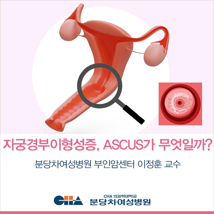 자궁경부 이형성증, ASCUS가 무엇인가요? _ 분당차여성병원 여성암센터 이정훈 교수 : 네이버 블로그