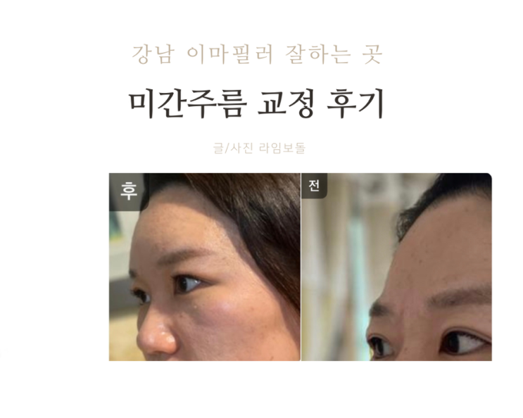 강남이마필러잘하는곳 이마필러+미간보톡스 찐후기! 가격, 통증, 붓기 : 네이버 블로그 강남이마필러잘하는곳 이마필러+미간보톡스 찐후기! 가격, 통증, 붓기 : 네이버 블로그