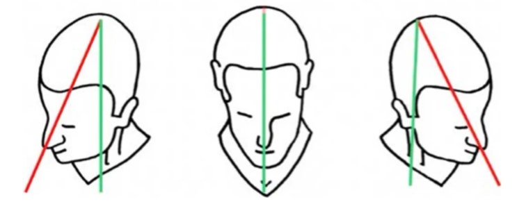 Cervical Flexion Rotation Test 상부경추 굴곡 회전 검사 : 네이버 블로그