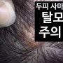 두피 사마귀 원인, 제거 치료는 두피열과 면역