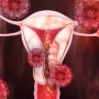 자궁내막암 새로운 면역 항암제 승인