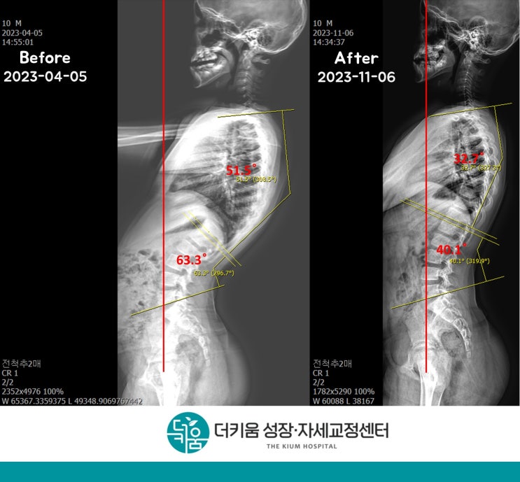 창원 자세교정 더키움병원의 과도한 요추전만 도수치료 전후 비교 : 네이버 블로그
