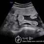[임신, 출산 기록] 임신 22주~26주차(임당, 질좌제)