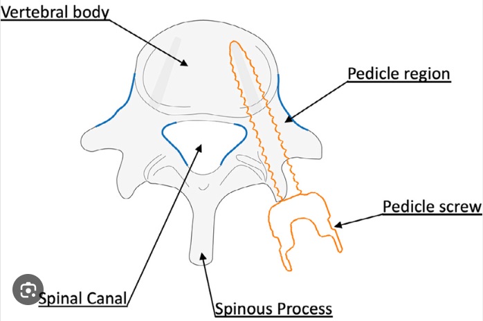 PPF(Posterior Percutaneous Fixation) : 네이버 블로그
