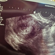 임신 4주6일, 임테기 역전과 함께 아기집 확인