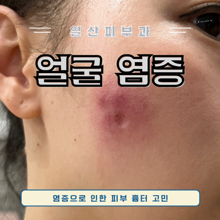 피부종기 얼굴에 여드름인지 종기인지 피부과 전문의 병원 찾아가세요 일산 피부과 : 네이버 블로그